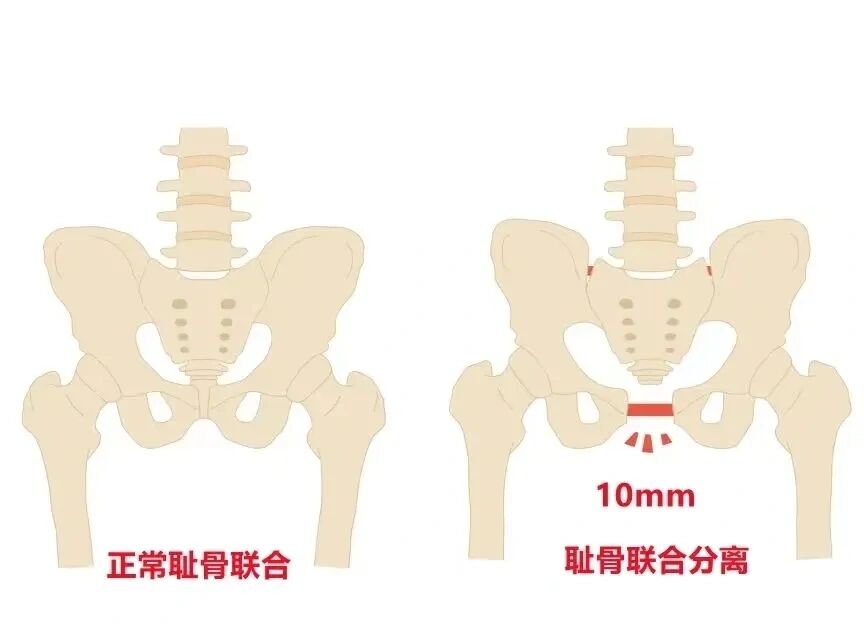 耻骨正常图片