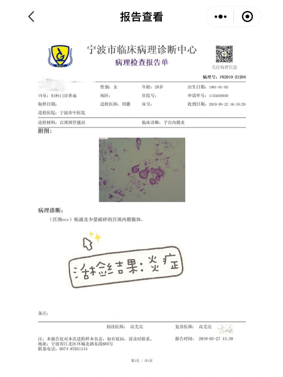 tct结果非典型鳞状细胞,不能明确意义 tct结果非典型鳞状细胞,不能