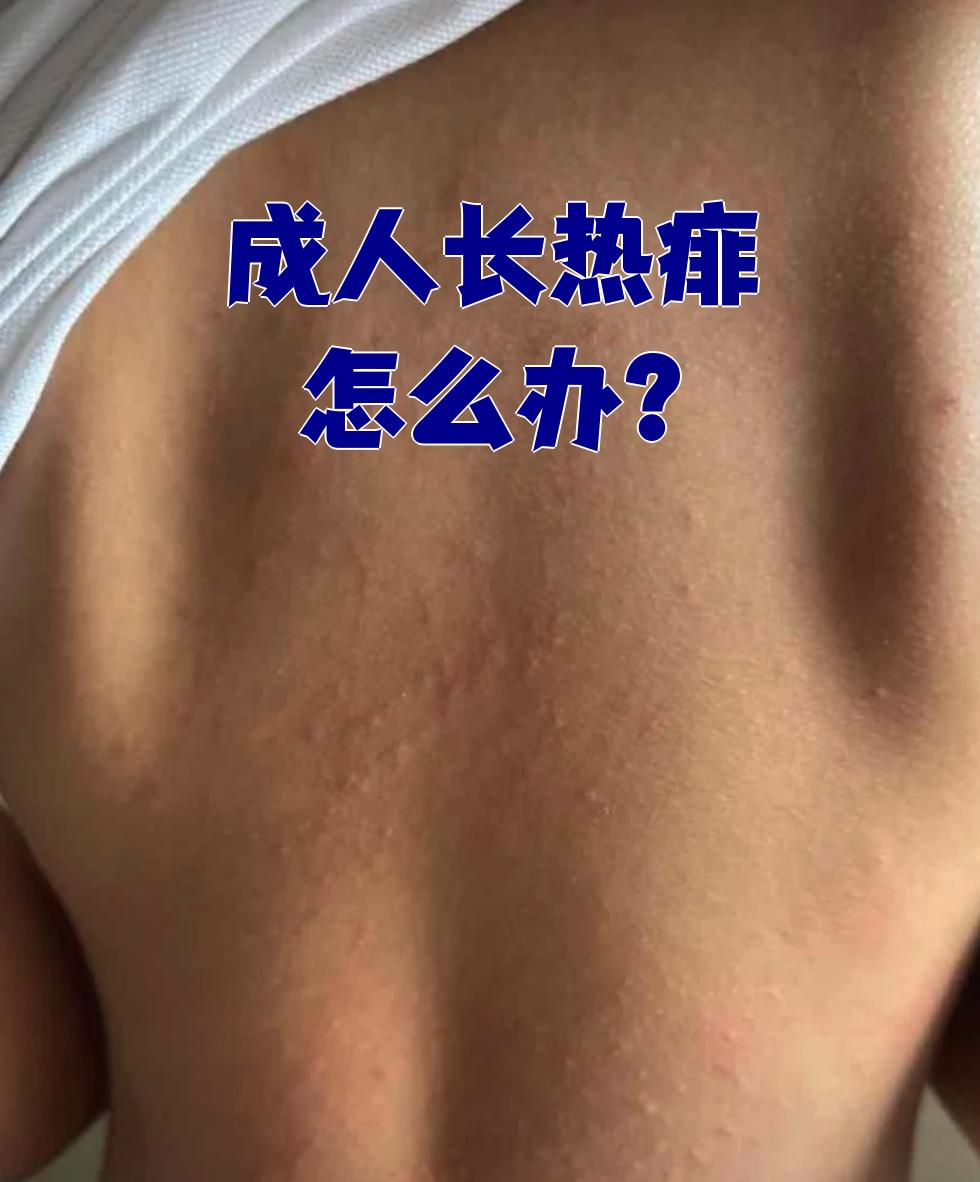 每天用温水清洗长热痱的地方,洗完后擦干,再扑点痱子粉.这