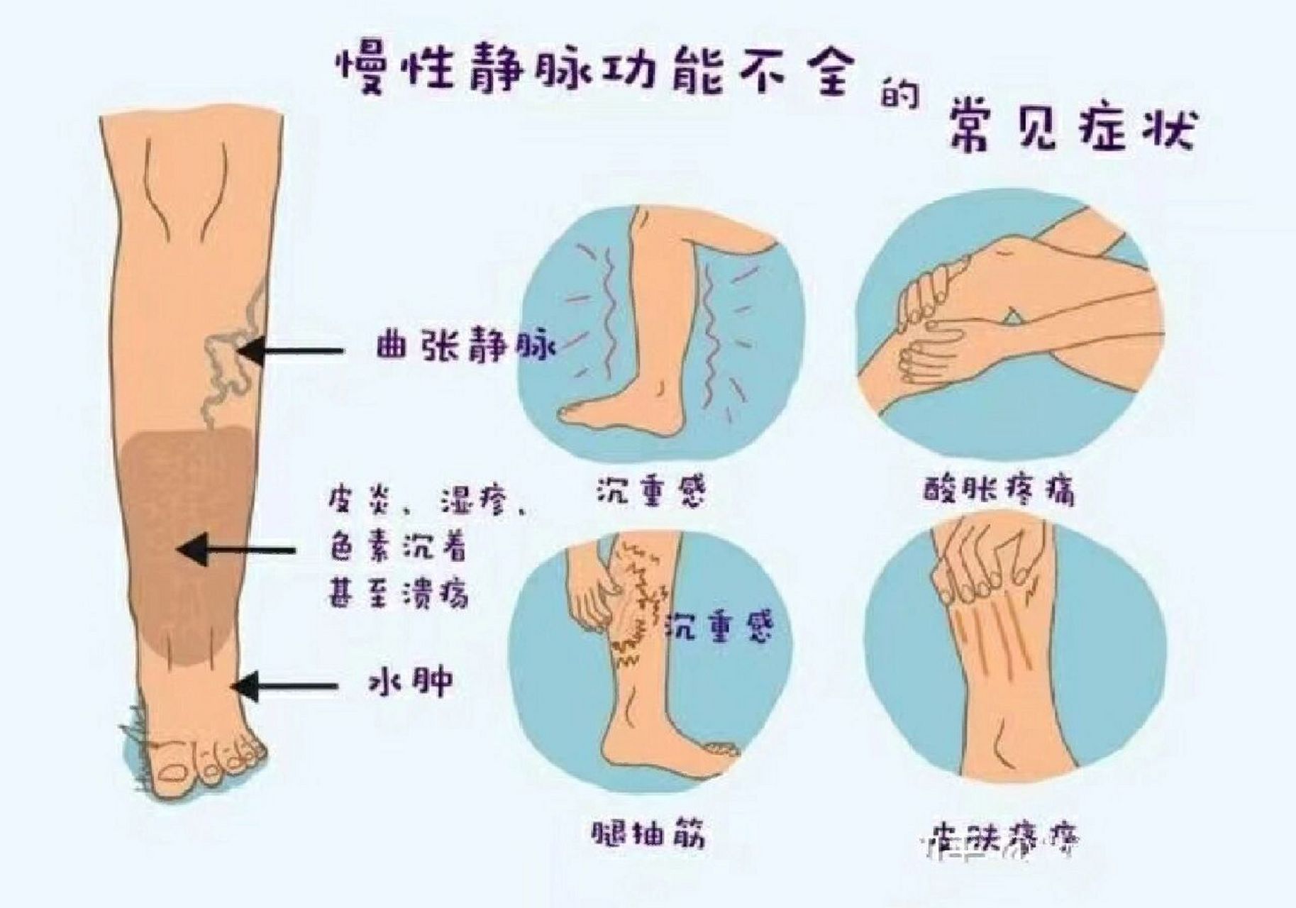 静脉曲张去医院挂什么科?