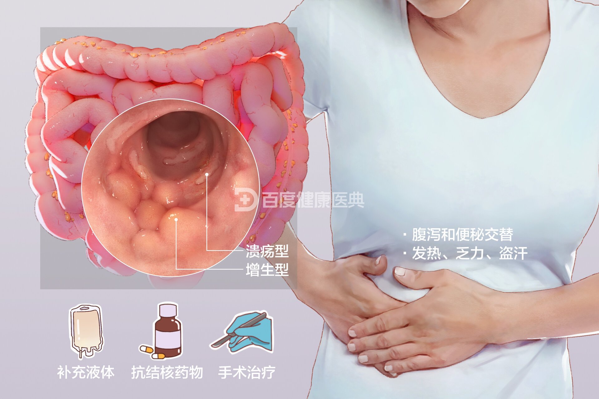 「消化系统」51566肠结核 7199好发部位:回盲部; 7199