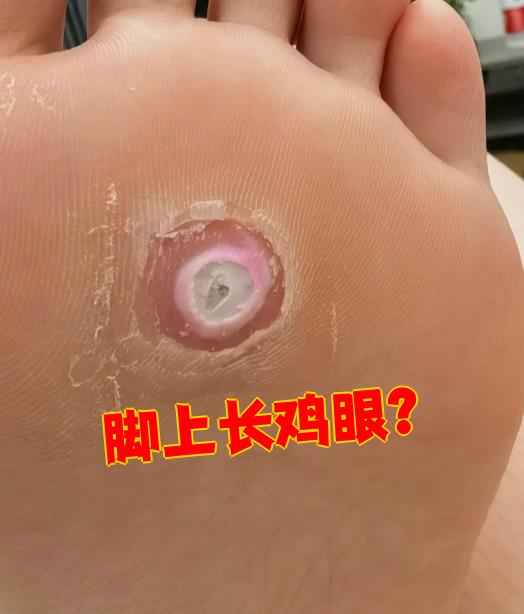 脚上长鸡眼主要是因为皮肤长期受到摩擦和挤压,导致局部角质增生