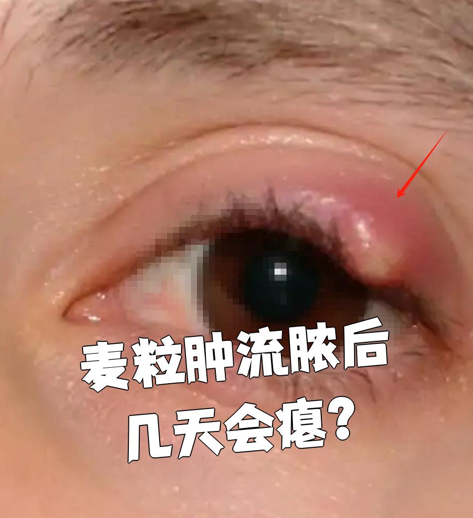 主要症状是眼睑红肿热痛