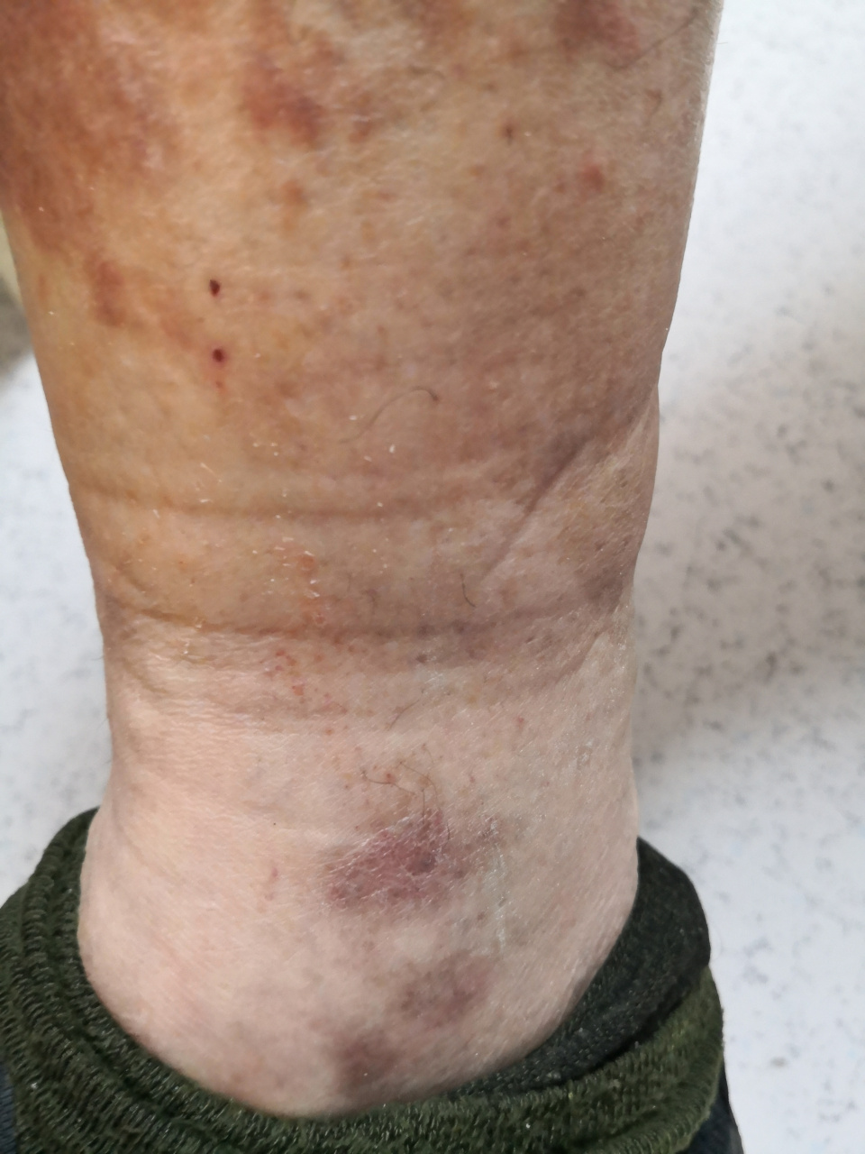 下肢淤积性皮炎图片图片