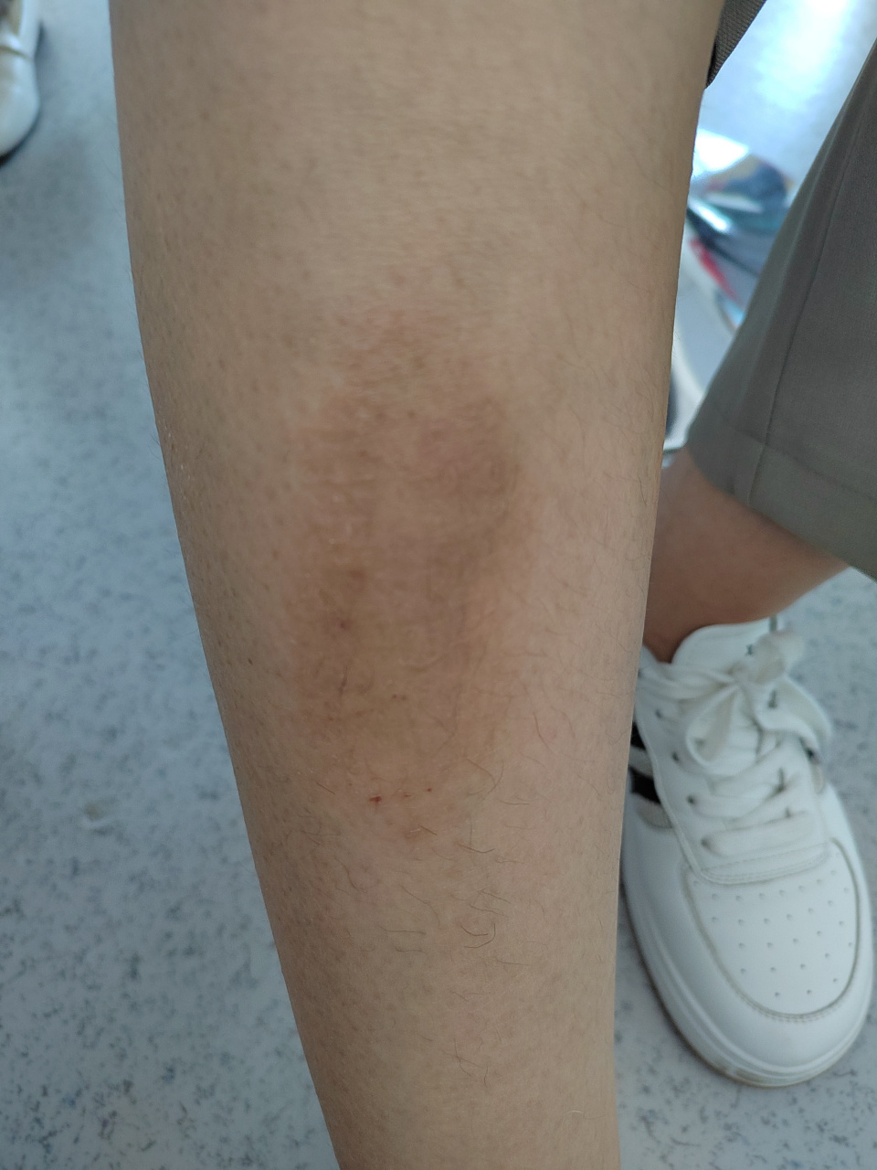 小腿胫前的色素沉着过度和皮肤粗糙症状.考虑淤积性皮炎可能.