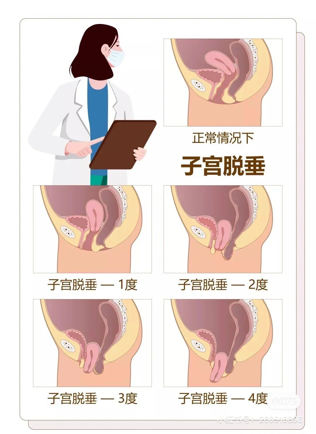 盆底肌松弛的危害 产后三大问题