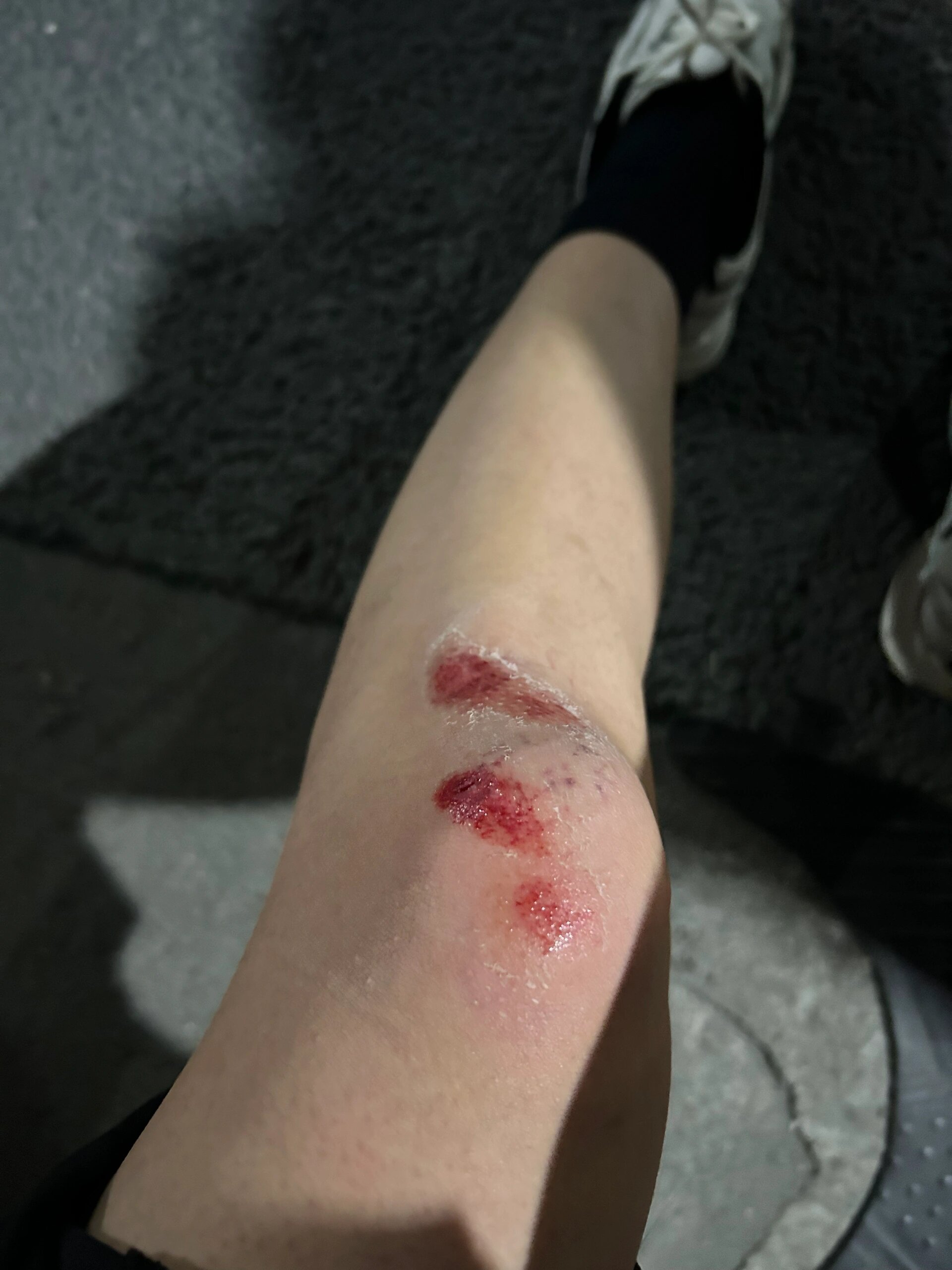 电动车交通事故 今天凌晨12点在银盆岭大桥骑电动车被一位逆行代驾