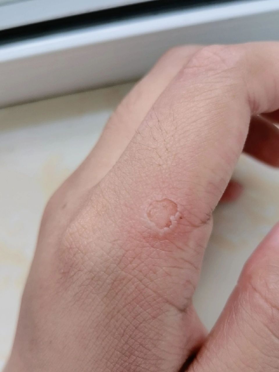 被热熔胶烫了 被热熔胶烫了一下,及时用清水冲过了,十分钟后变成了