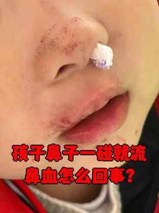 孩子鼻子一碰就流鼻血,最常见的原因是鼻腔黏膜太薄或者有炎症