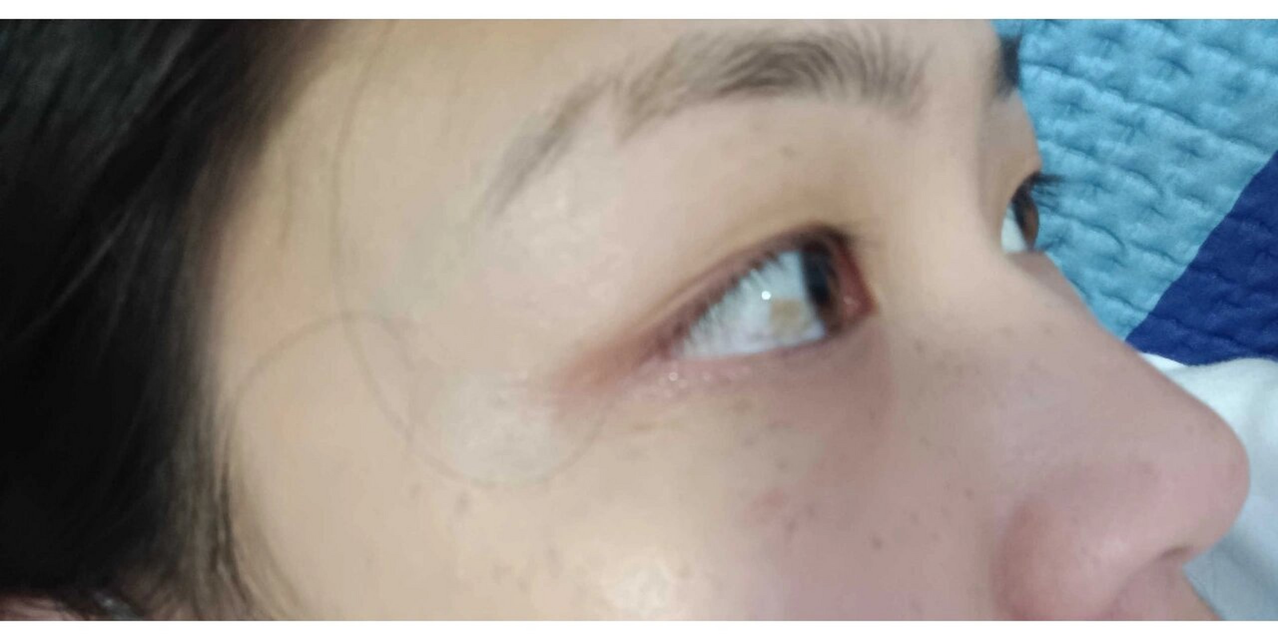 眼白色素痣 眼睛里这块色素已经很多年了,不敢跟人对视,怕别人发现,还
