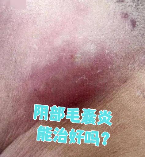 阴部毛囊炎也叫外阴毛囊炎,是能够治好的