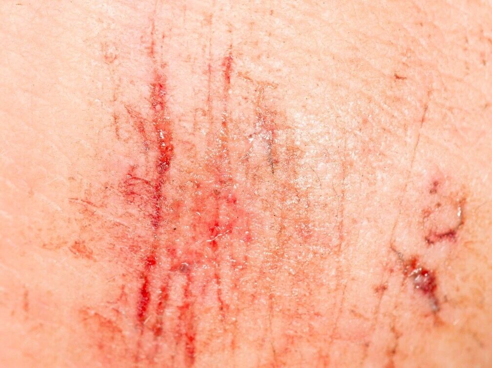 浅擦伤 先将伤口用温开水或自来水进行来回清洗,然后涂抹上红药水就