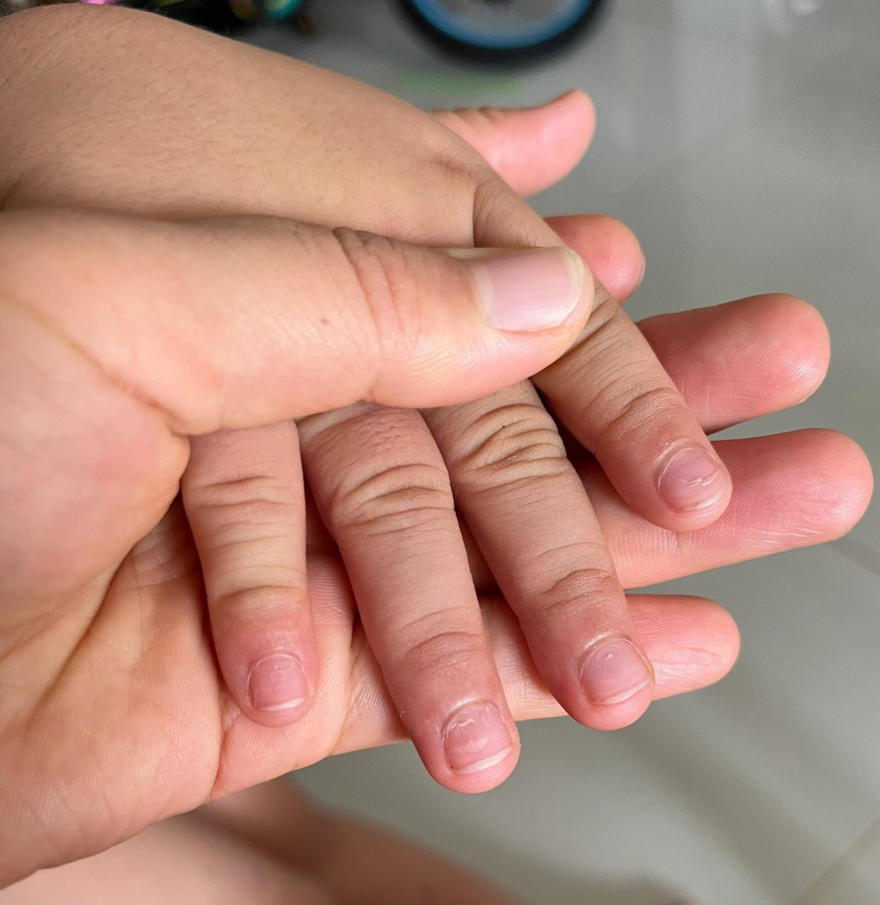 孩子指甲凹陷有断层是怎么回事 今天才发现的这个情况,有宝妈知道是