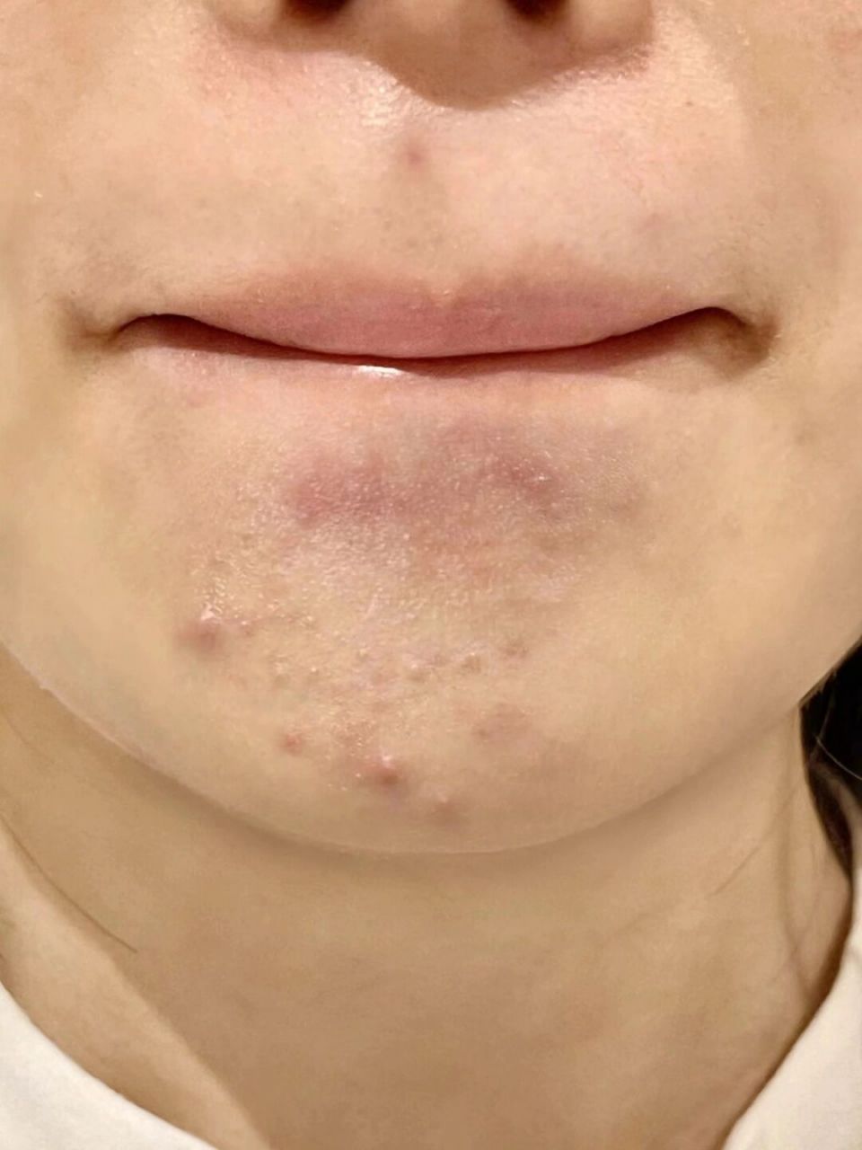 满下巴闭口就这样没了! 这个精华液去闭口属实是泰牛了!