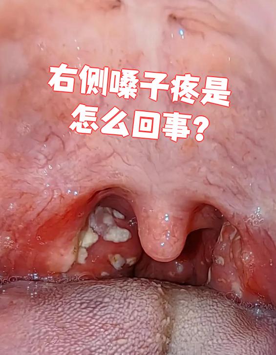 右侧嗓子疼最常见的原因是咽喉炎或扁桃体炎