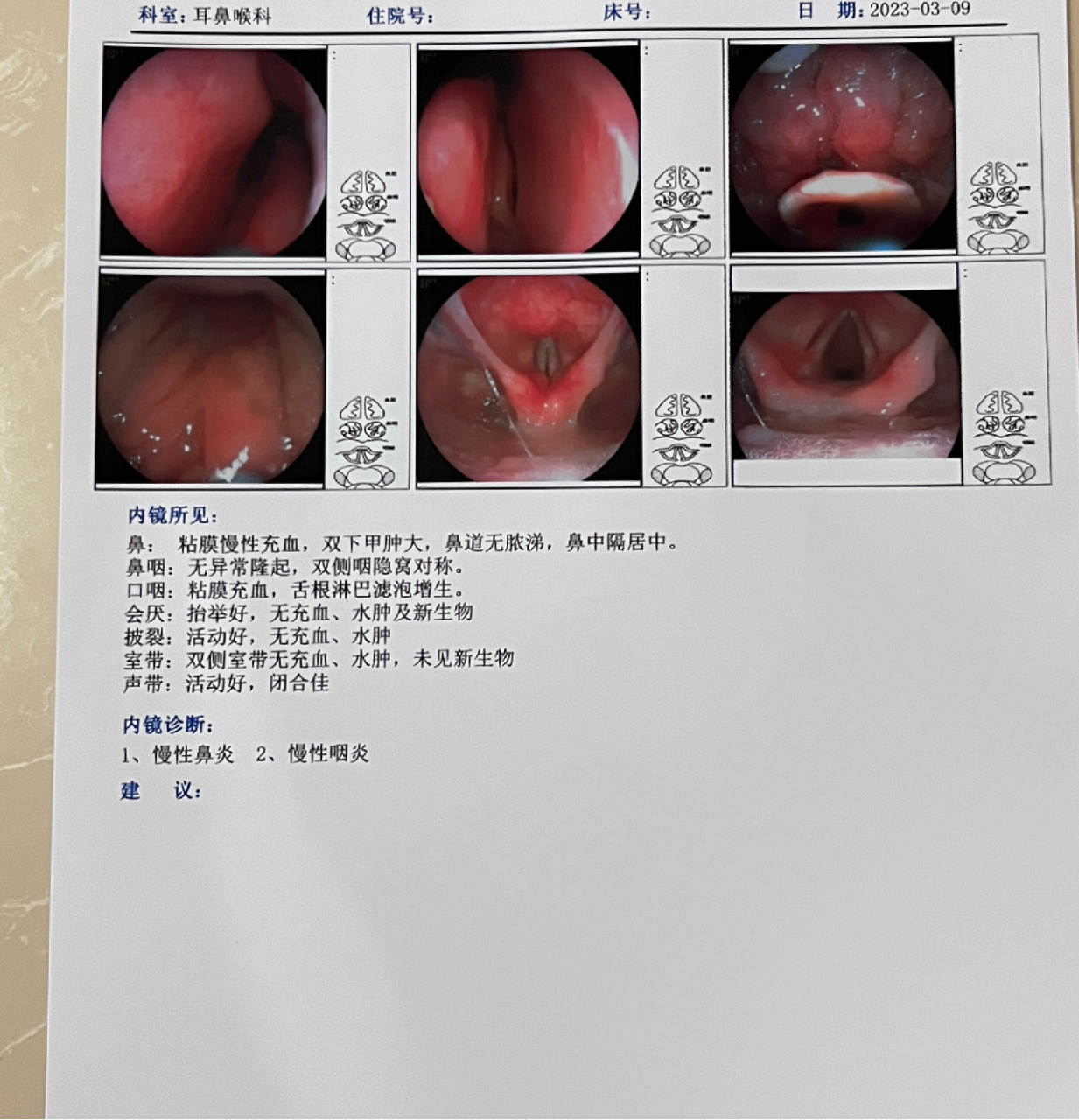 口腔滤泡增生怎么治疗图片