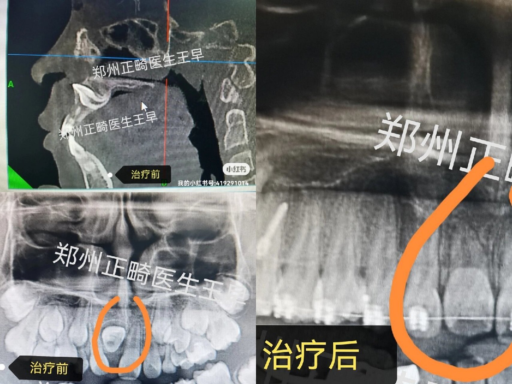 倒置埋伏上中切牙(门牙)牵引 埋伏牙的形成病因很复杂,主要原因有3