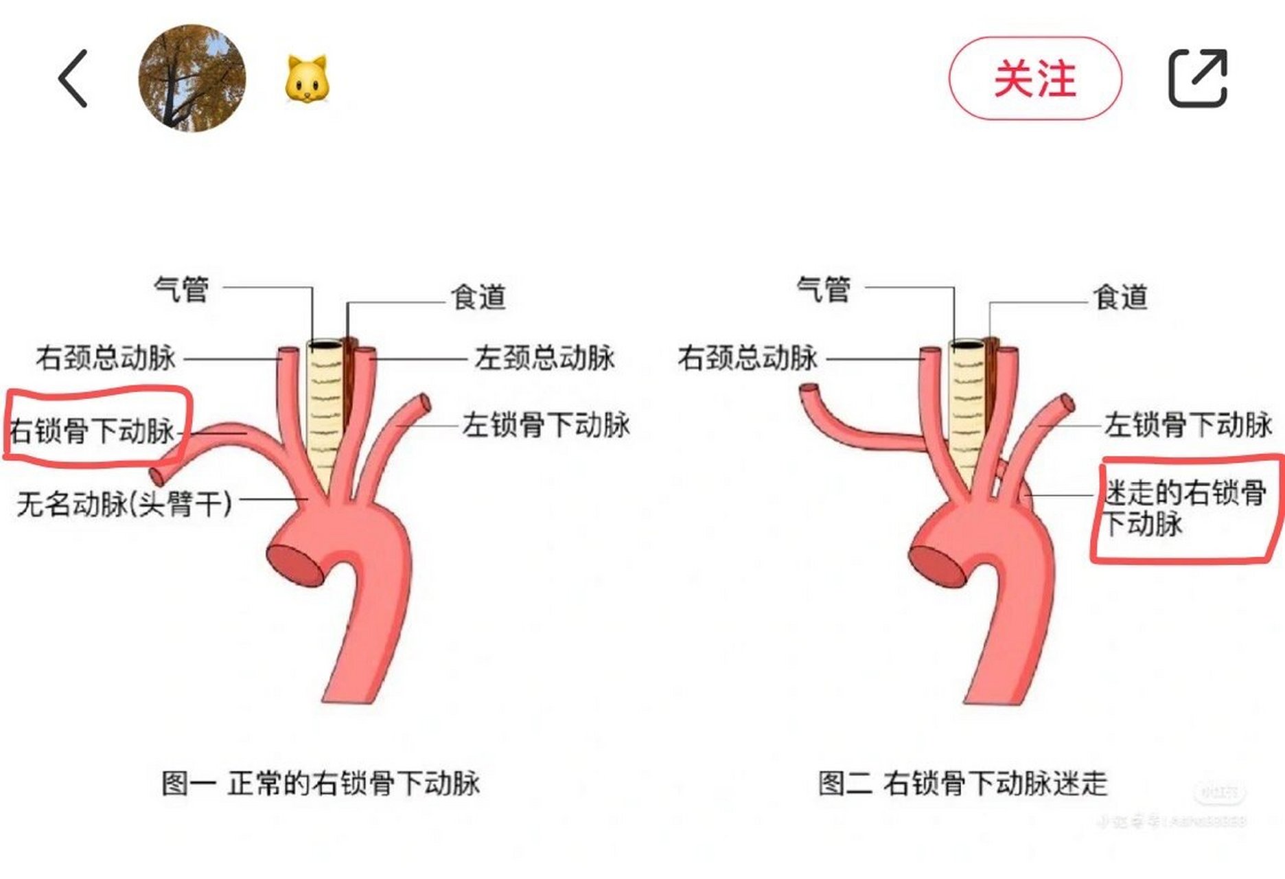 锁骨下动脉ct图片