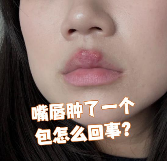 嘴唇肿包可能由以下原因引起: