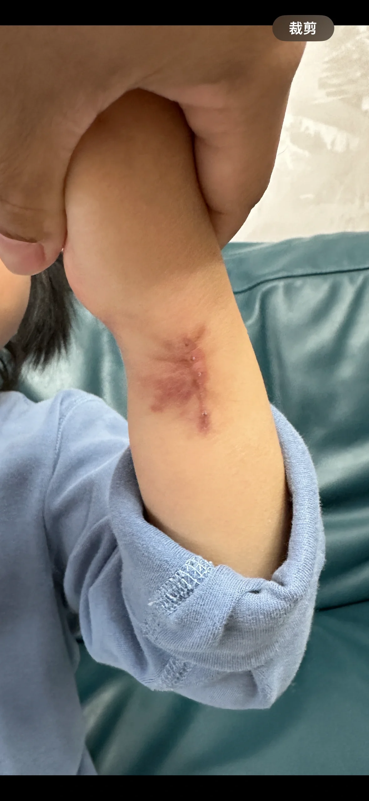 伤口愈合后变红了怎么处理呢?