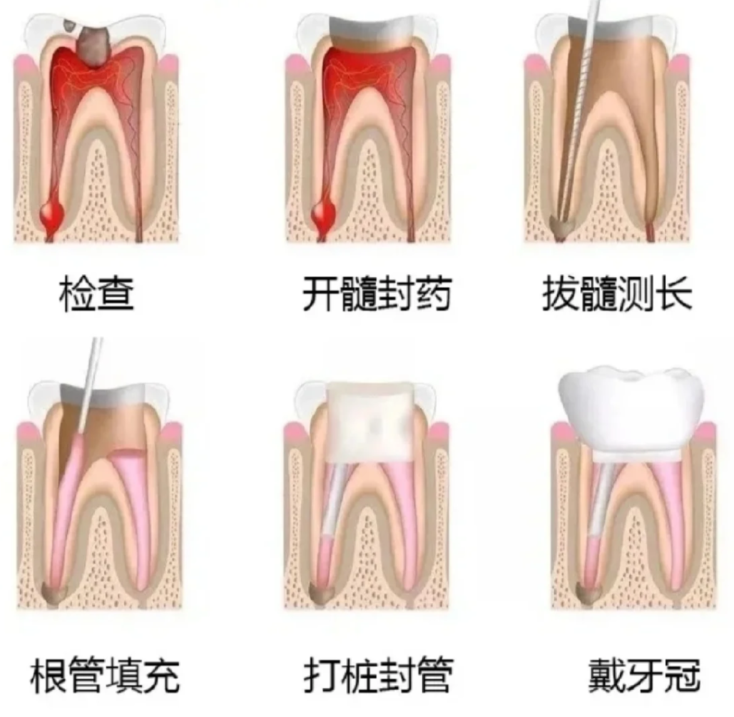 根管治疗主要用来治牙髓病(牙髓炎)和根尖周病
