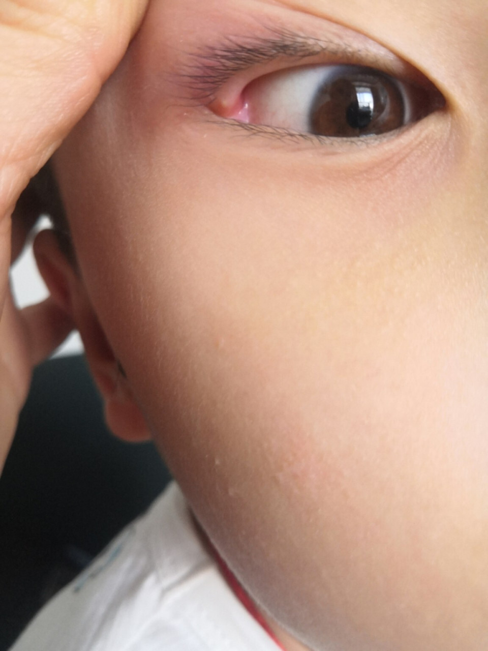 眼睛边上有疙瘩 孩子早上起来发现眼睛疼,我一看眼睛边上长了一个疙瘩