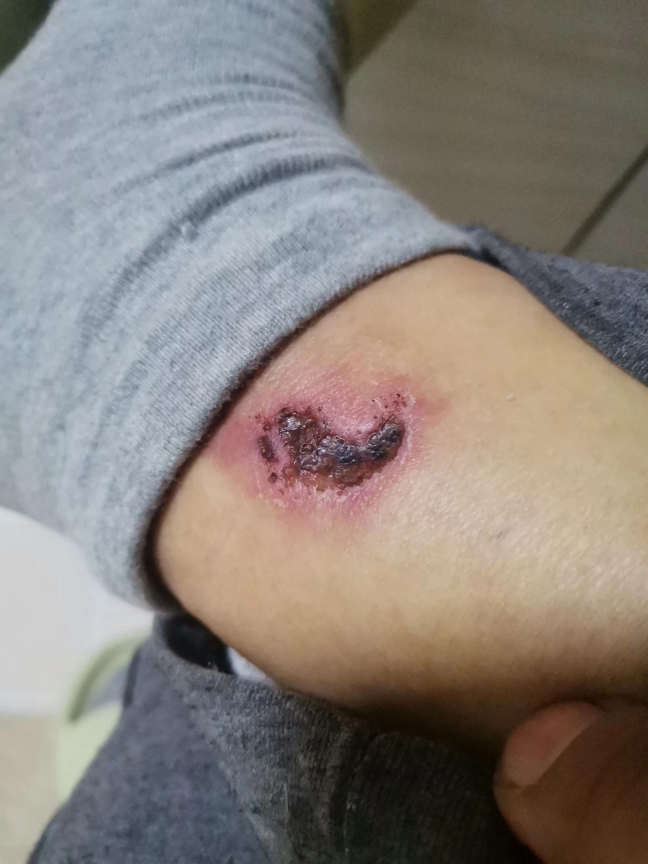 前几天逗大家玩儿说我受伤了,其实当时只是擦破了点皮儿!