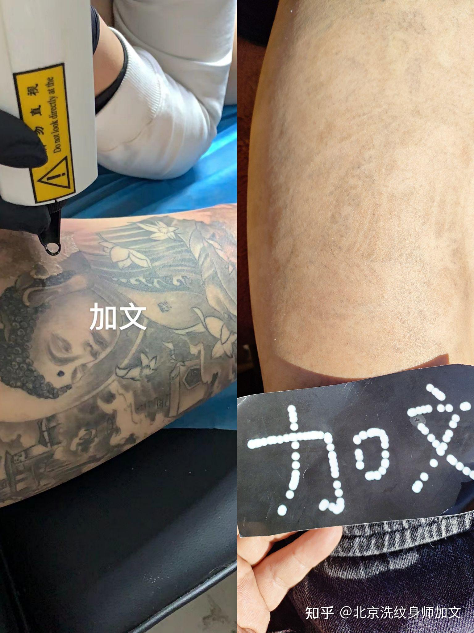 济南现代皮肤病医院洗纹身效果好吗