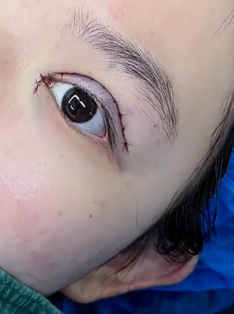 双眼皮做深一点通常更好,因为维持时间更长,看起来也更自然