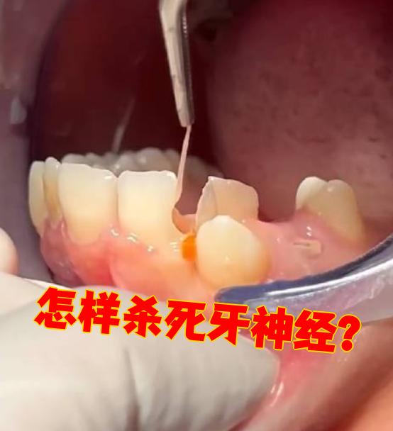 杀死牙神经主要有两种方法:打麻药直接拔除神经,或者用药物让神 