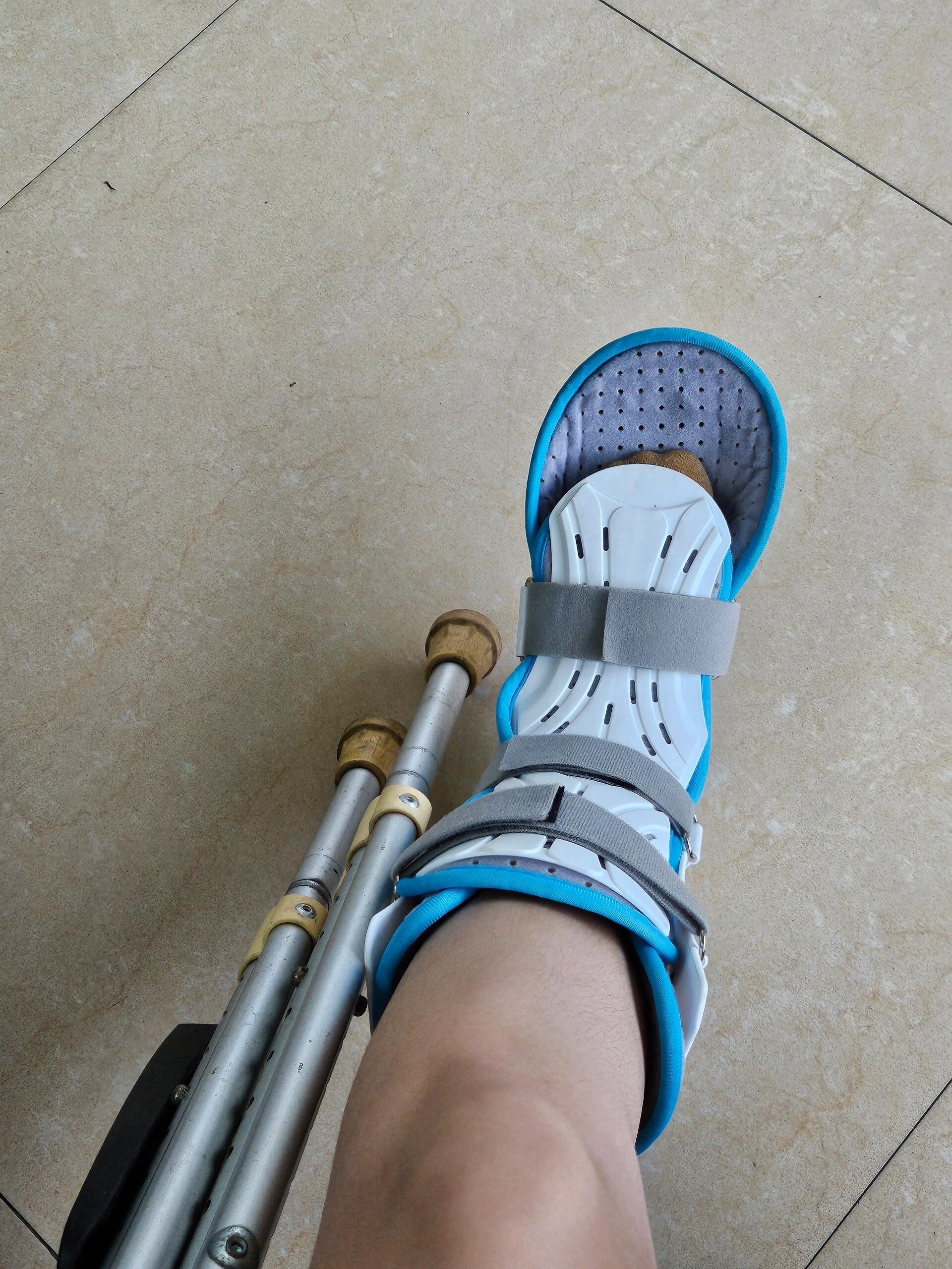 崴脚韧带断裂 医生建议保守治疗