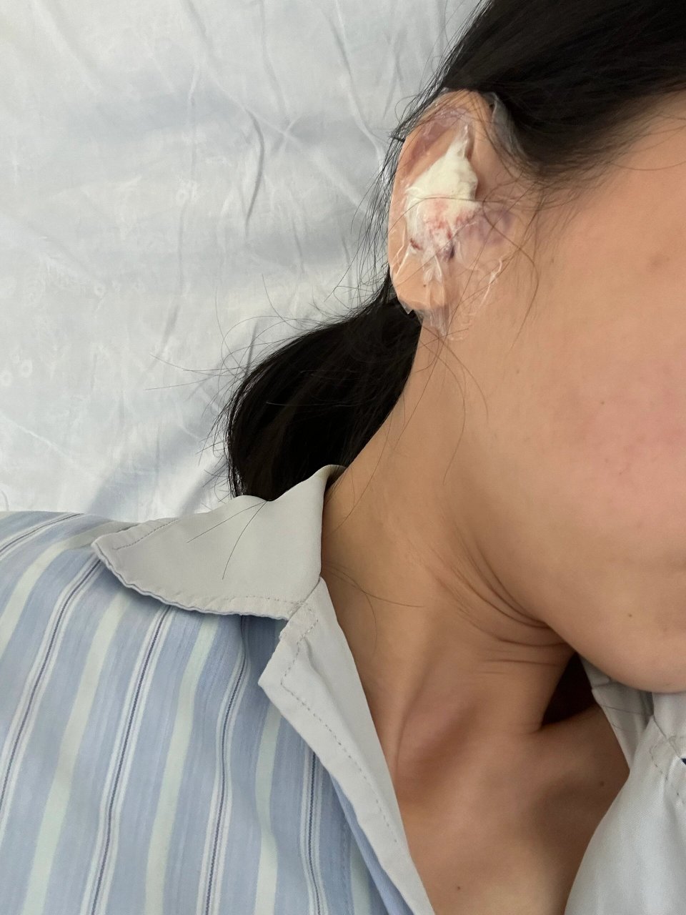 上海五官科医院耳膜修复手术 no1:很小的时候就一直有中耳炎,随着年龄