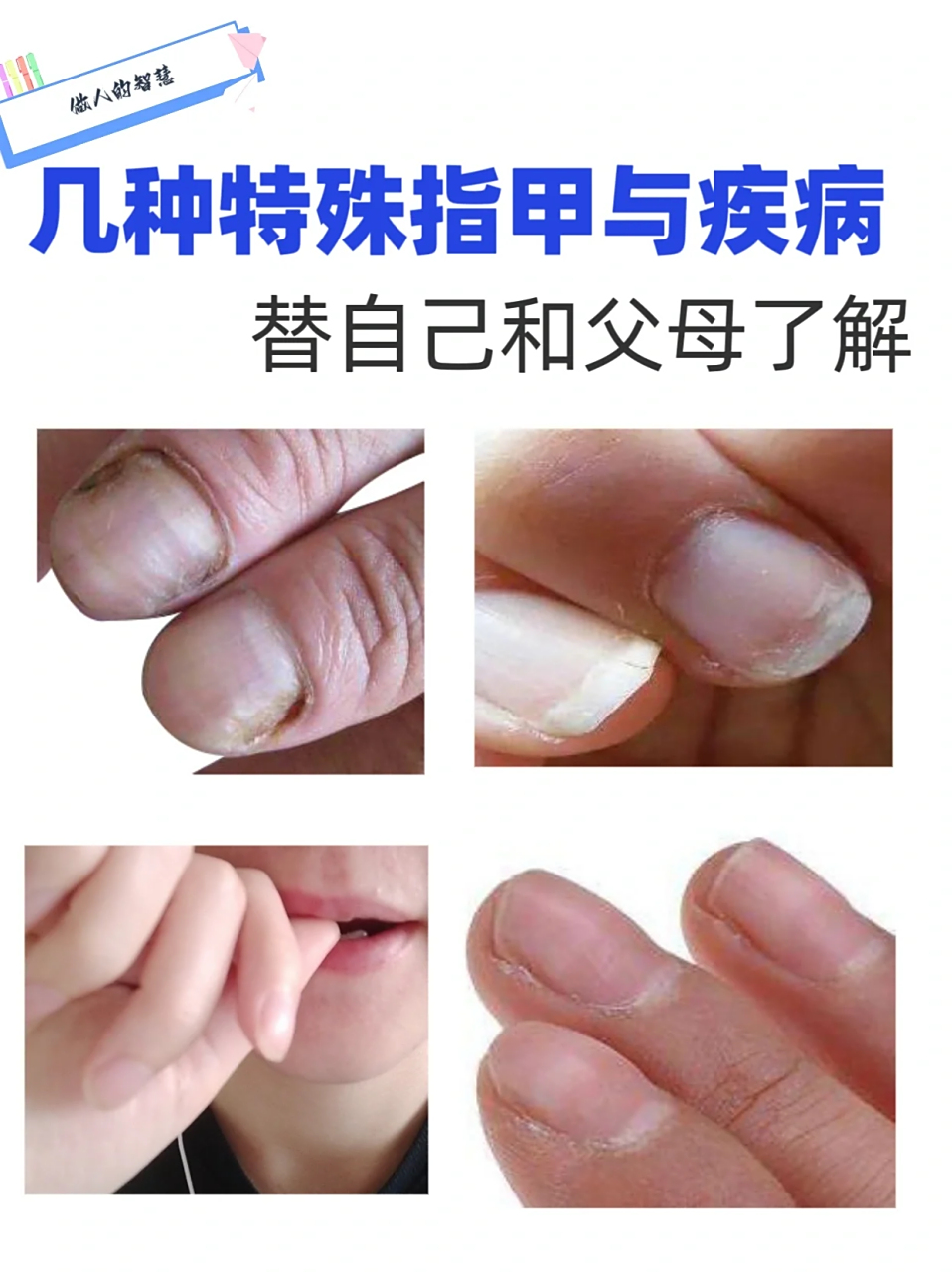 几种特殊指甲与疾病 指甲的形状可以反映出身体的健康状况,快来看看你