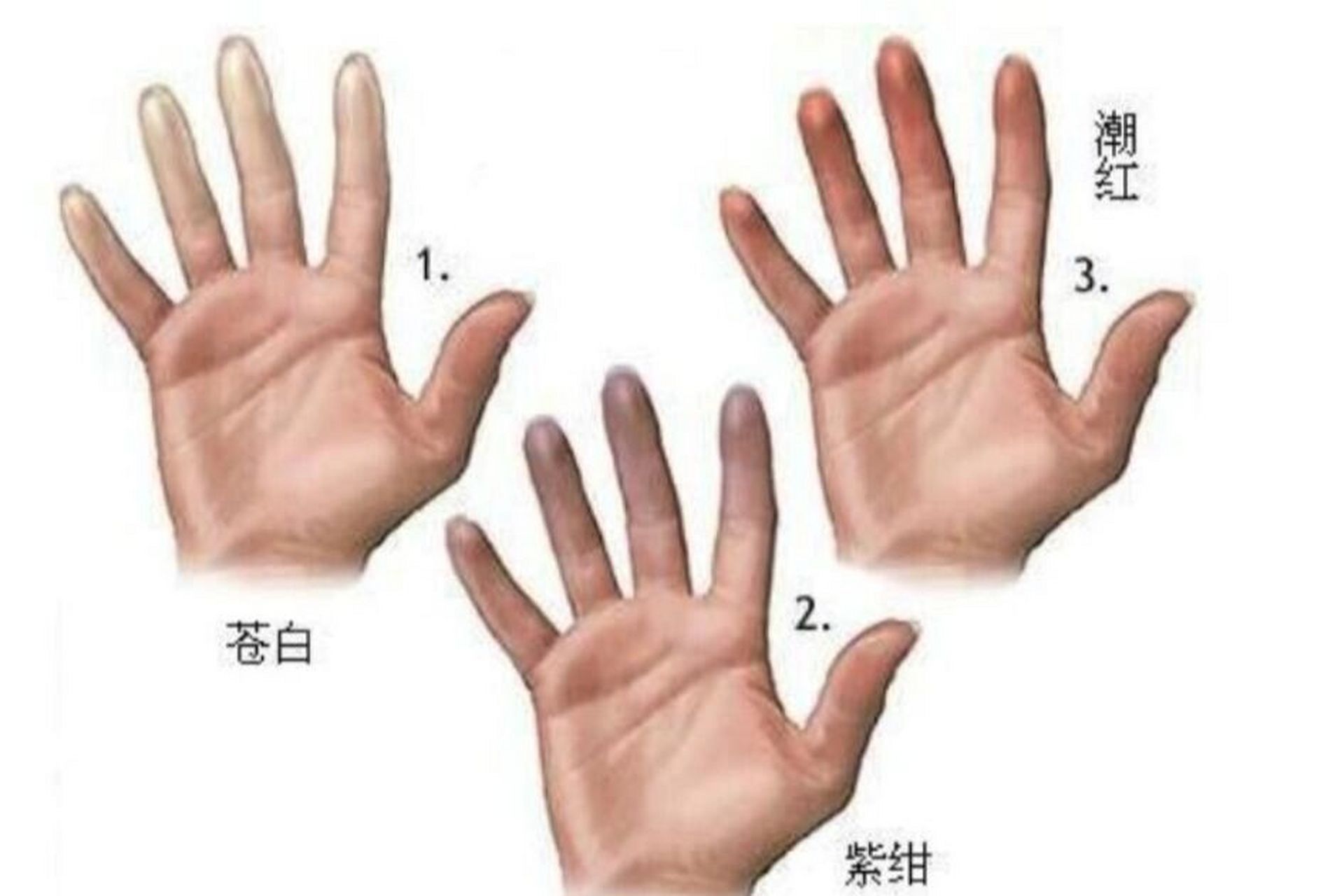 【简单聊聊~~雷诺综合征】 雷诺综合征是肢体末梢经常发生的病症,最近