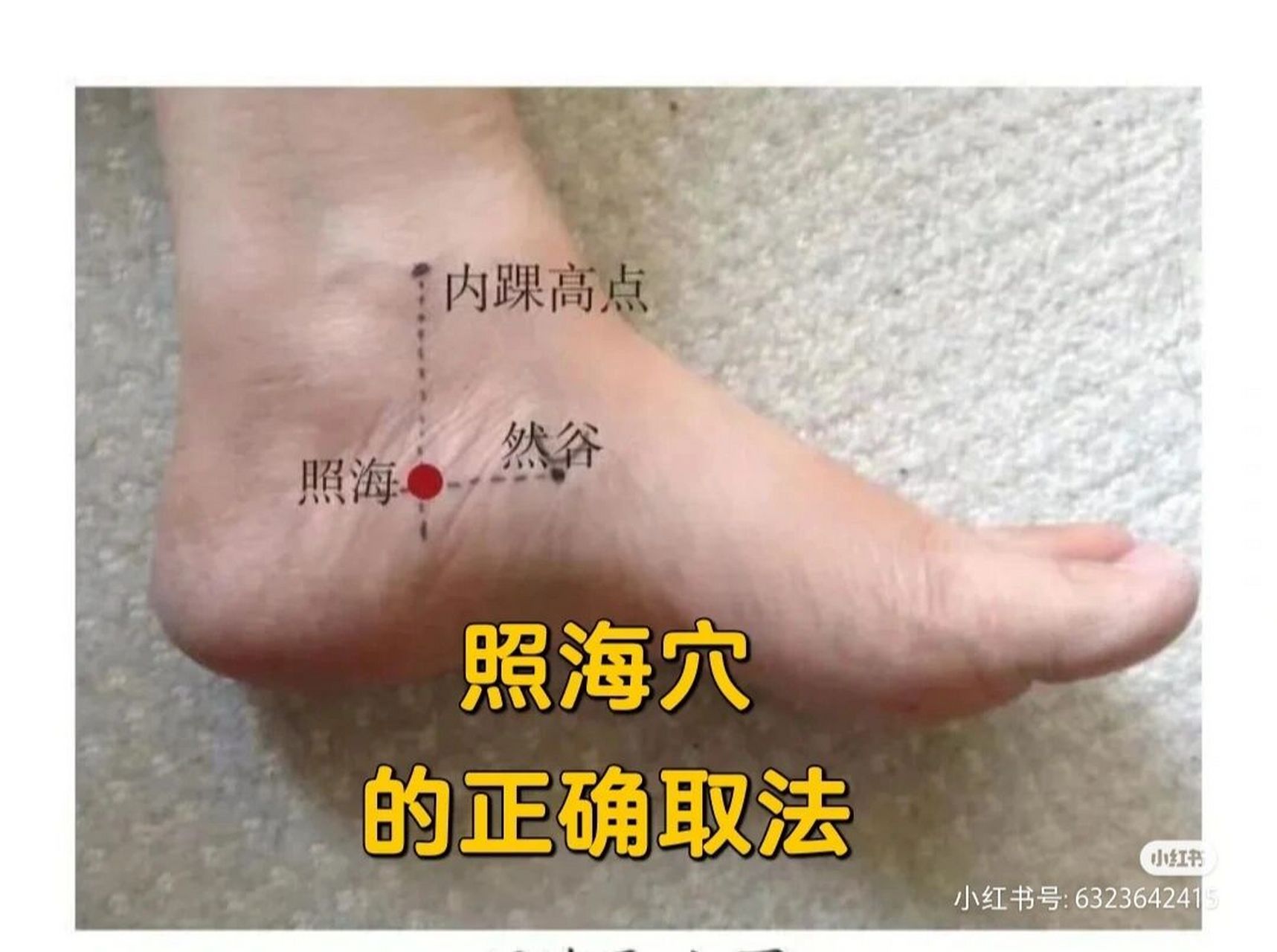 照海穴扎针实践 跟着小红书 的照海穴穴位找法,进针后脚底有电麻感