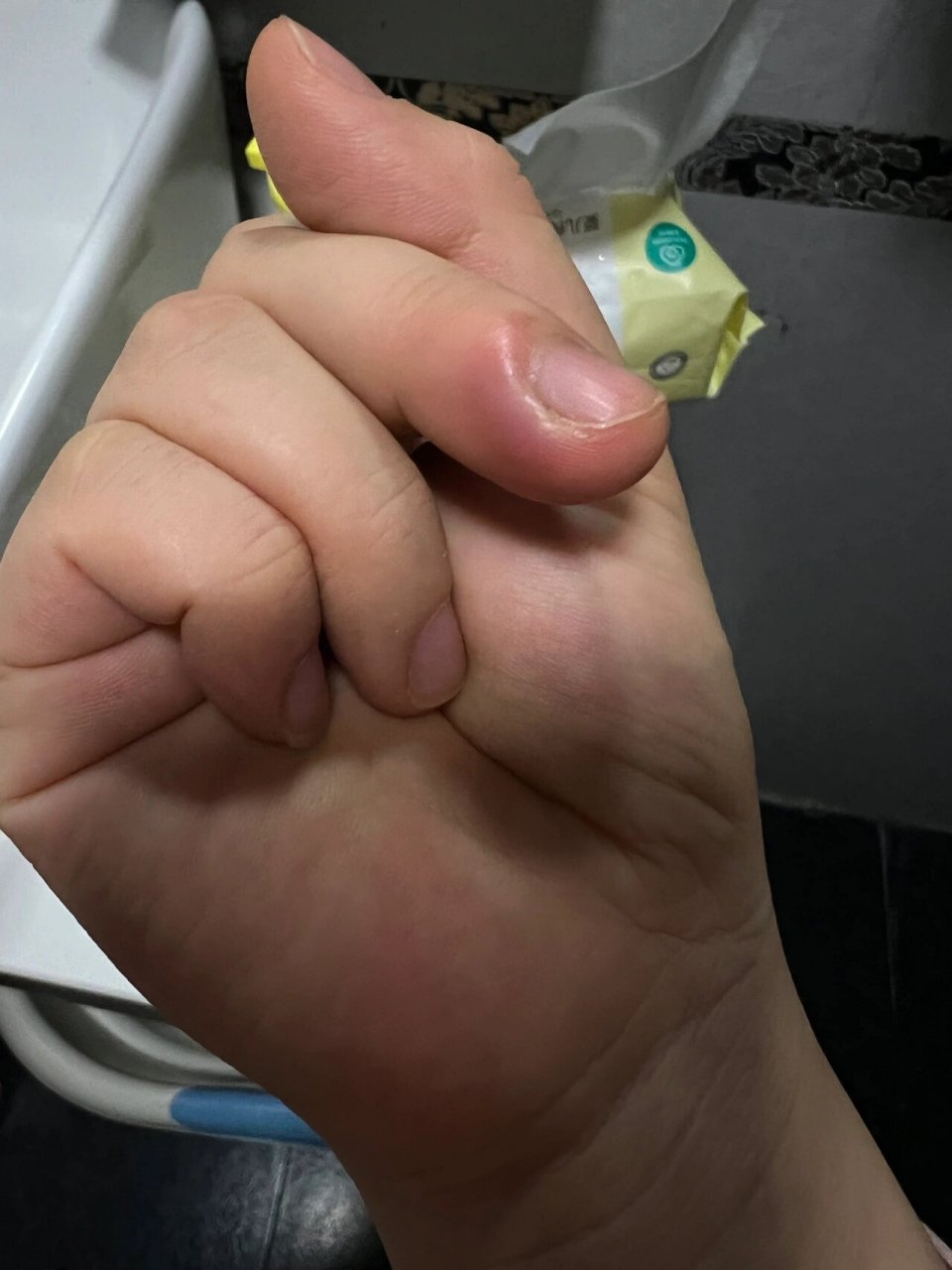 前几天拔了倒刺 发现手指头肿了 表面光滑.