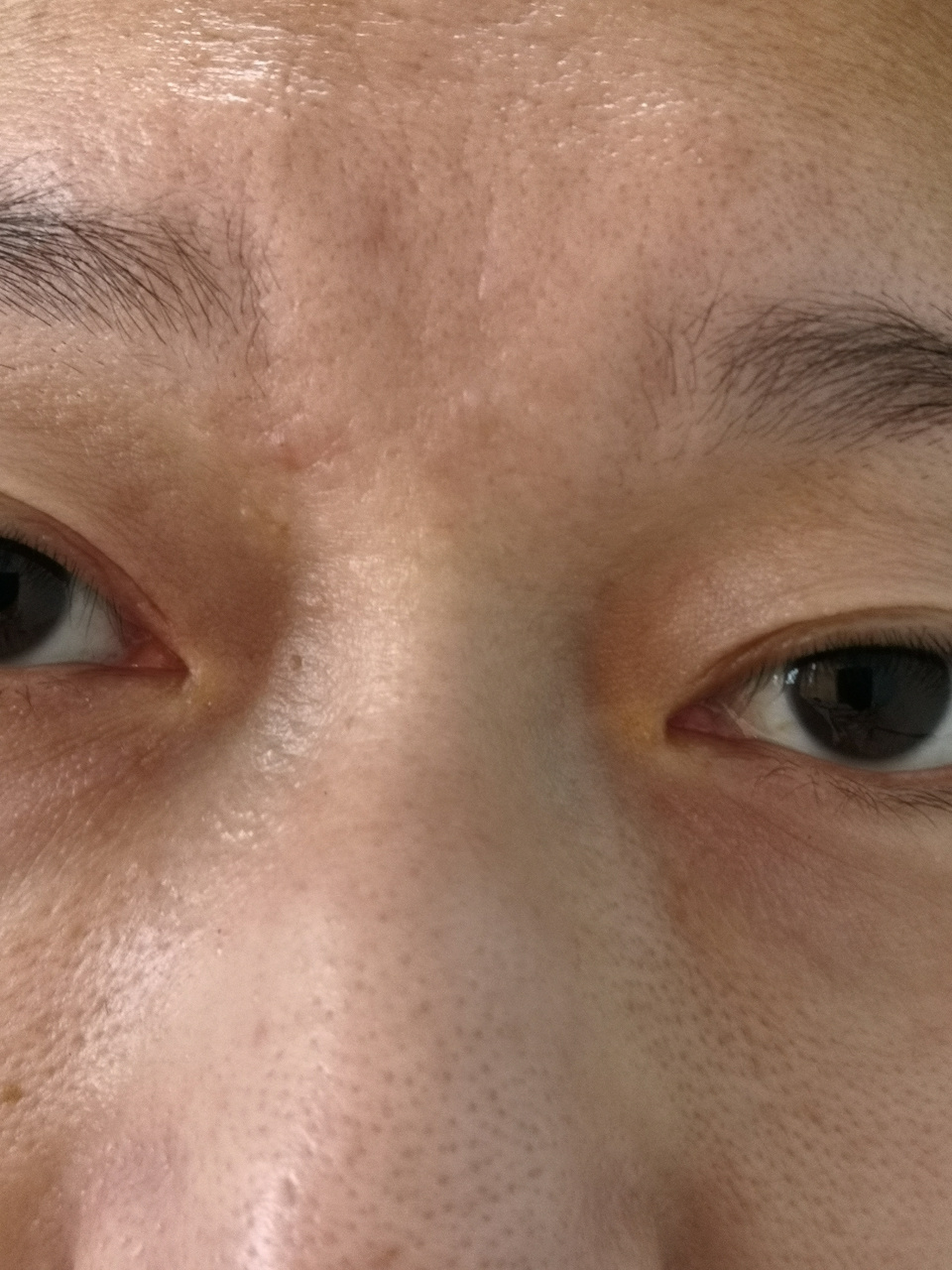 眼睑内眼角褶皱部位的颗粒物.#解决皮肤问题专注皮肤美容##皮赘