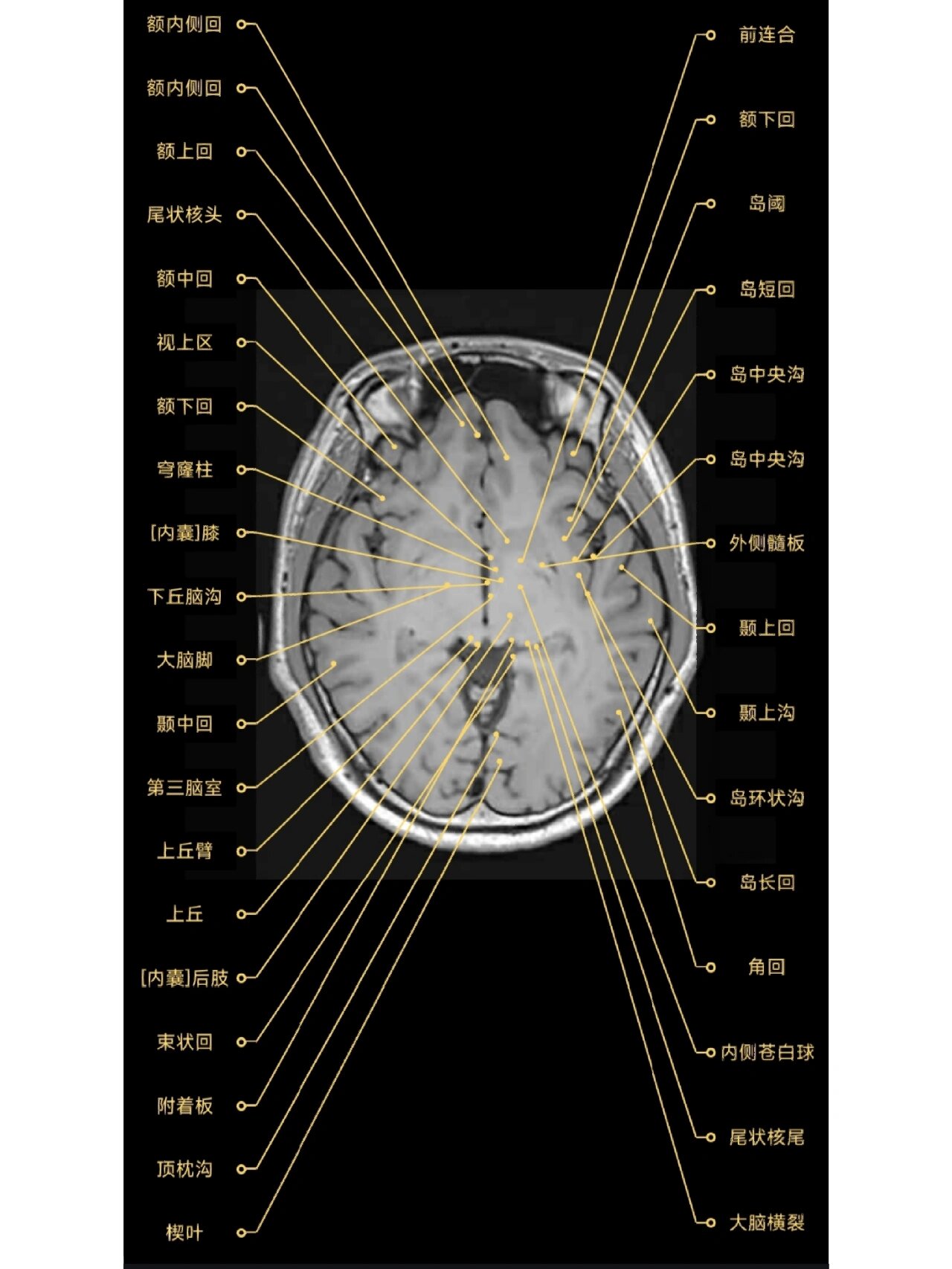 颅脑mr解剖