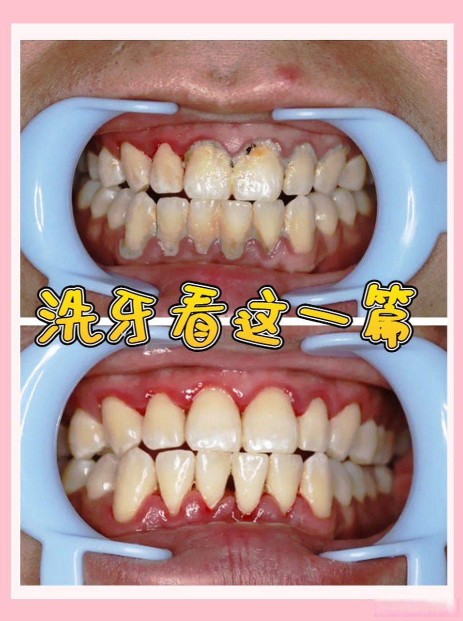 如果没有非常严重的牙科疾病,比如牙龈炎,牙周炎这些情况,那么洗牙是