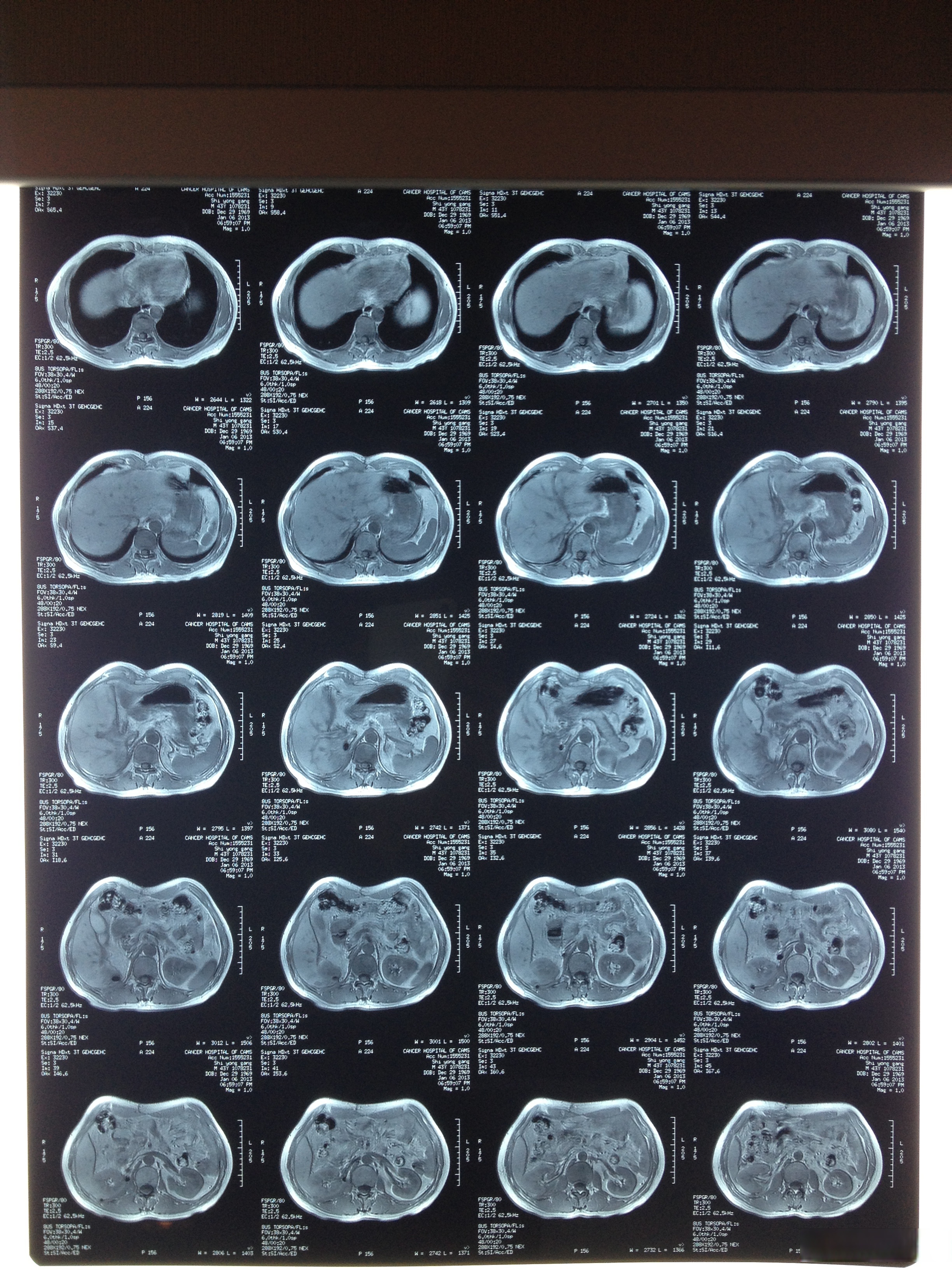 国内医院为何至今无法取消过时的ct胶片?