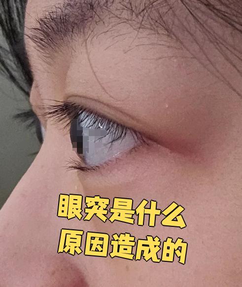 这种情况需要尽快去甲状腺科用药控制,否则眼球突出会越来越严重