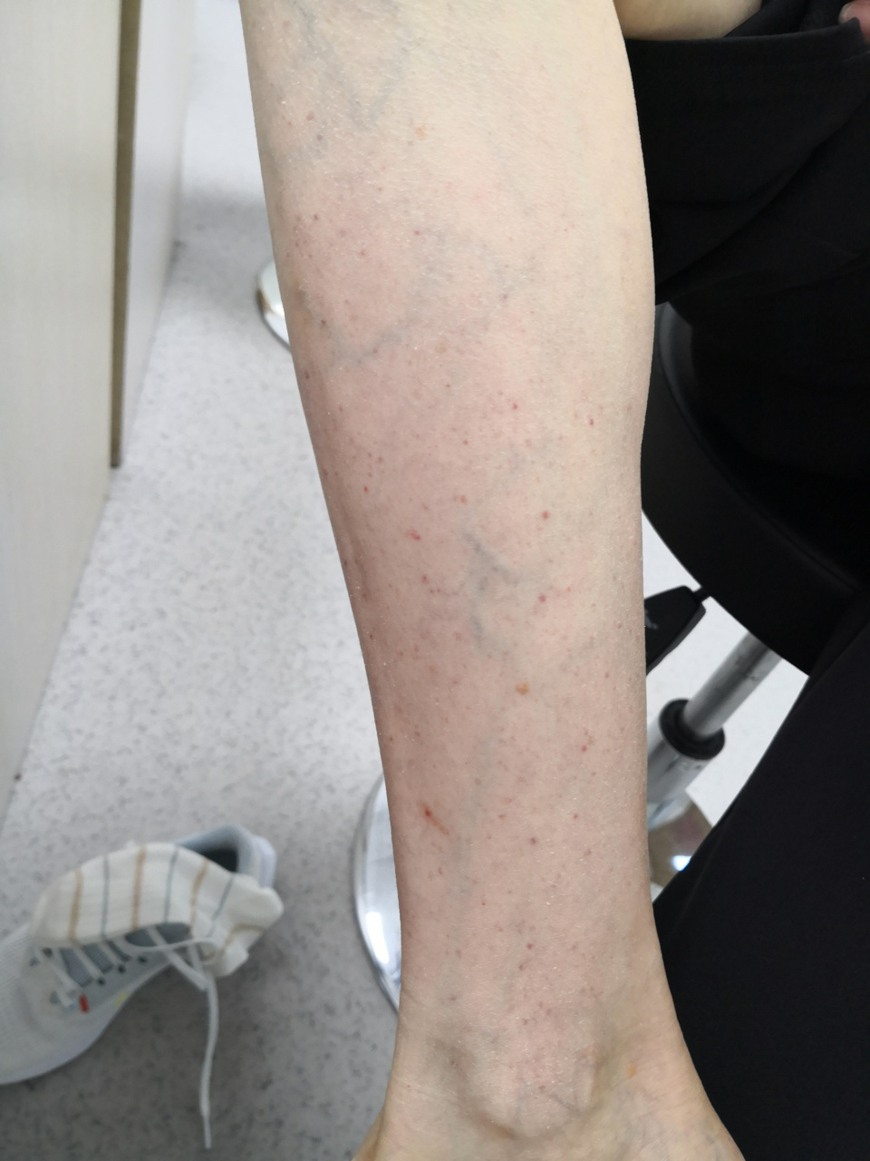 考虑过敏性紫癜症状#解决皮肤问题专注皮肤美容##紫癜