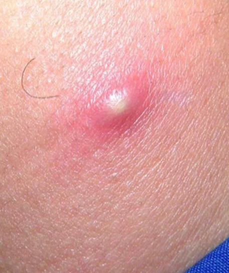 屁股上长了个包越来越大,可能是臀部疖肿,皮脂腺囊肿,脂肪瘤,纤析瘤