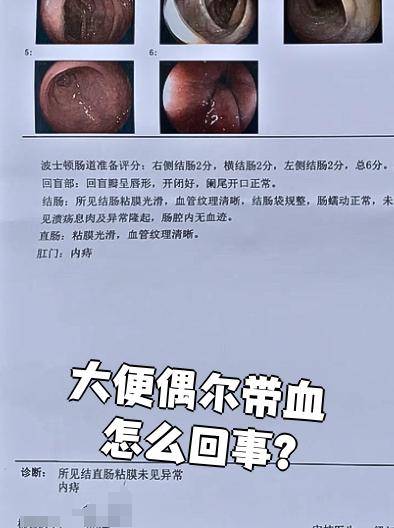 拉屎为什么有血出来百科在线 拉屎为什么有血出来百科在线