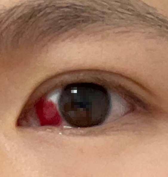 这是球结膜的毛细血管破裂后,血液渗到结膜下形成的
