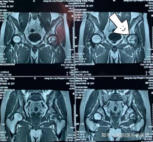年轻小伙长期服用激素股骨头坏死微创髓芯减压植骨成功保髋