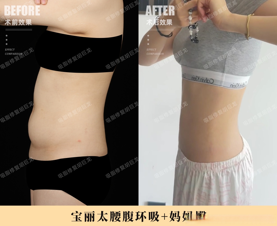 宝丽太腰腹环吸 妈妈臀,术后8个月反馈~  腰腹部是女性最容易堆积脂肪