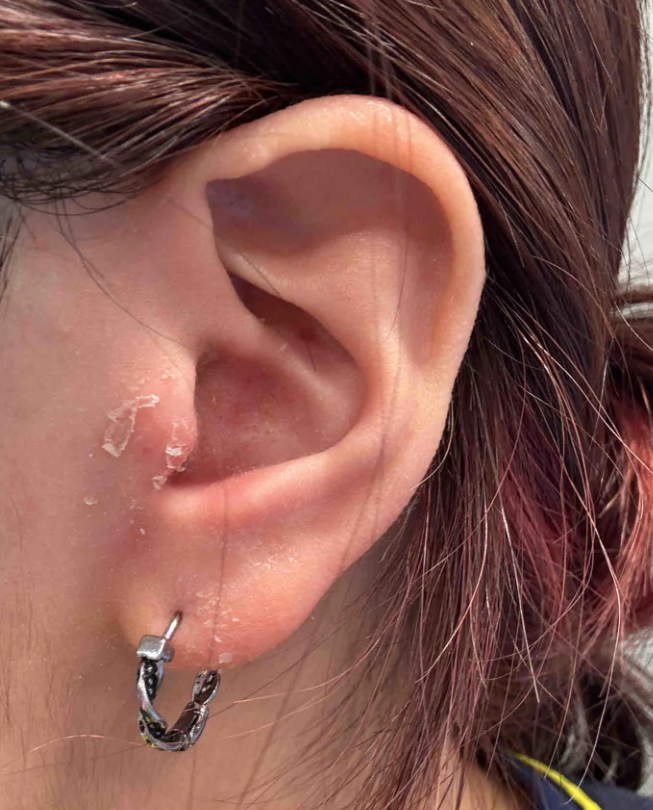 耳朵脱皮像头皮屑,常见原因有耳廓慢性皮炎,耳廓湿疹,真菌感染和