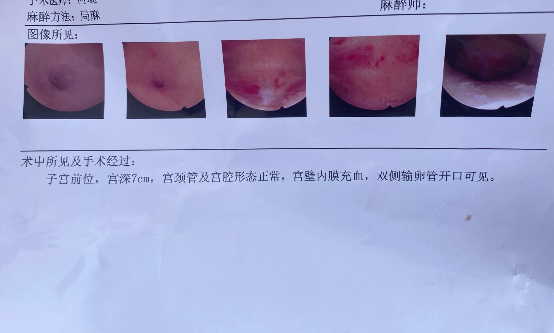 宫腔粘连 中度 中度粘连 6度 宫腔镜下手术一个月后复查通过, 怀着无