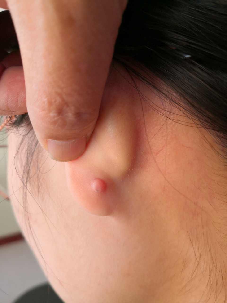 扎耳洞后出现的瘢痕疙瘩症状